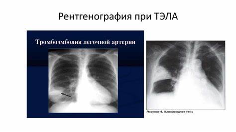 Диета при тромбоэмболии легочной Тромбоэмболия легочной артерии. Диагностика, лечение - презентация онлайн Тромбоэмболия легочной артерии. Диагностика, лечение - презентация онлайн Диета при тромбоэмболии легочной