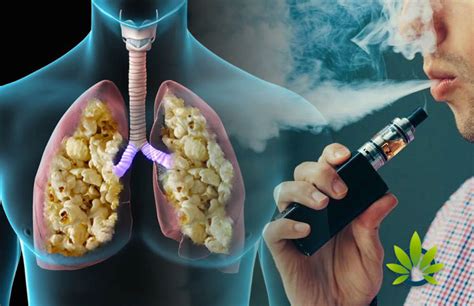 Does Vaping Lead To Popcorn Lung Disease Here Is What You Need To Know Advken Blog