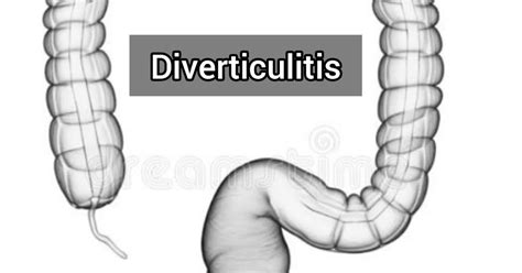 Diverticulitis Symptoms Causes Diagnosis Treatment Melody Jacob