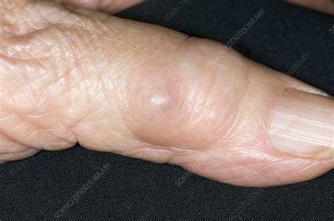 Synovial Cyst On The Finger Stock Image C Science Photo Library