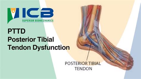 Pttd Posterior Tibial Tendon Dysfunction Youtube