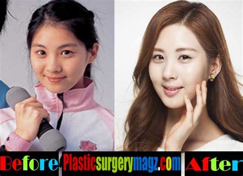 Seohyun Snsd Plastic Surgery Before And After Plastic Surgery Magazine