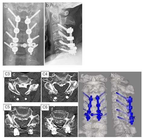 Jcm Free Full Text Efficiency Of Long Lateral Mass Screws
