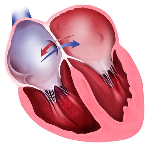 Heart With Atrial Septal Defect Medmediasolutions