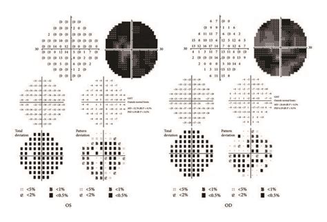 The Goldmann Visual Field Of Both Eyes A Shows The Defect In All