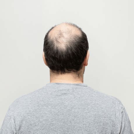 A genuine breakthrough in hair loss research is this latest breakthrough is up there with the best of those discoveries. Breakthrough In Research To Find A Cure For Male Pattern ...
