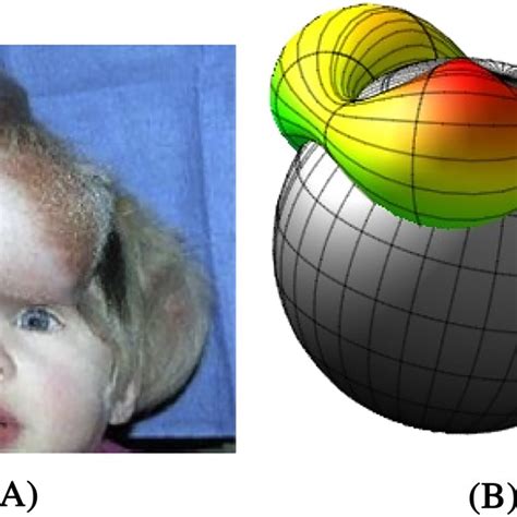 A Tissue Expansion In Pediatric Forehead Reconstruction It Shows