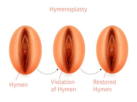 Hymenoplasty Hymen Restoration Revirgination Surgery In Chennai DG Laser Cosmetic