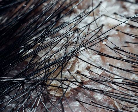 Dry Scalp Causes Treatment And Prevention