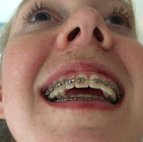 Summers Double Jaw Surgery Blog Nhs Getting Braces