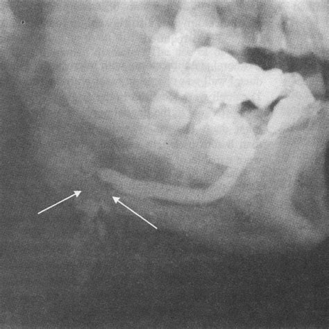 Sialography Catheter Is Inserted In The Orifice Of Submandibular Duct