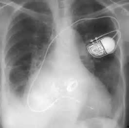 Does it give you shocks? Module Pacemaker/ICD - Medisch Spectrum Twente