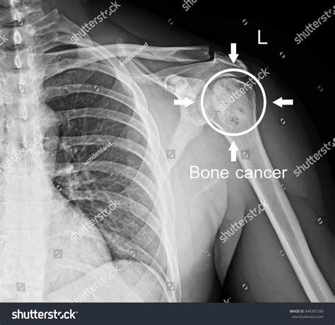 Bone cancer is rare, making up less than 1 percent of all cancers. Bone Cancer Shoulder Stock Photo 444387289 - Shutterstock