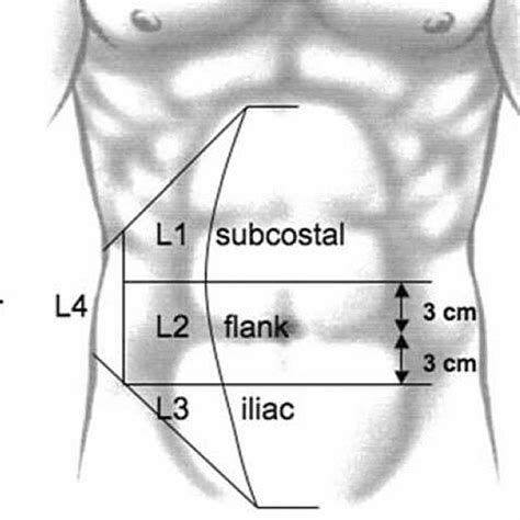 Patient Position And Port Placement For Repair Of A Flank Area Hernia