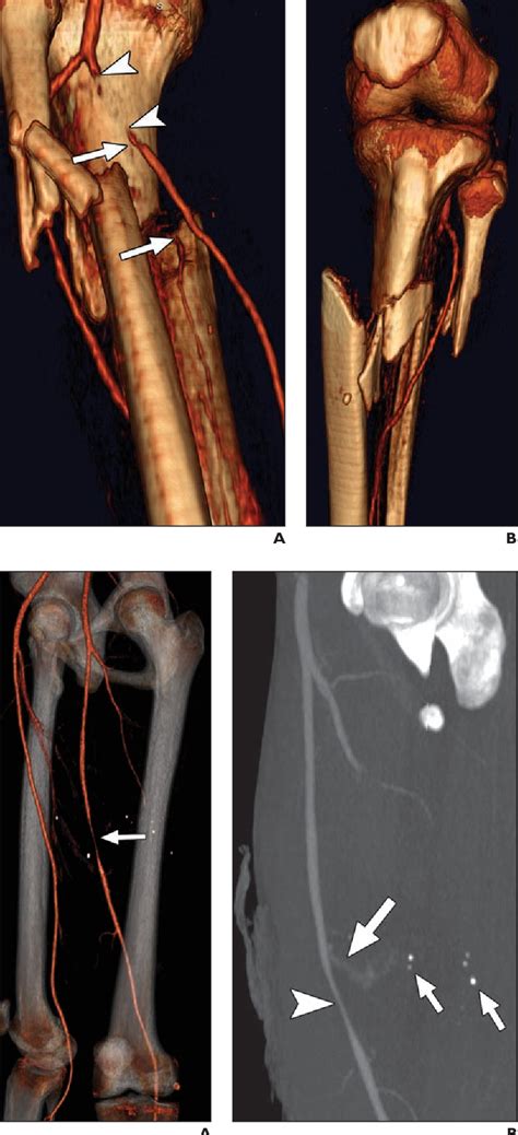 Figure 11—45 From Ct Angiography Signs Of Lower Extremity Vascular