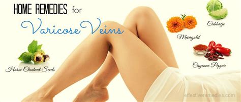 20 Natural Home Remedies For Varicose Veins On Legs And Face