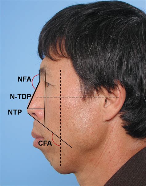 Lengthening The Short Nose In Asians Facial Plastic Surgery Jama
