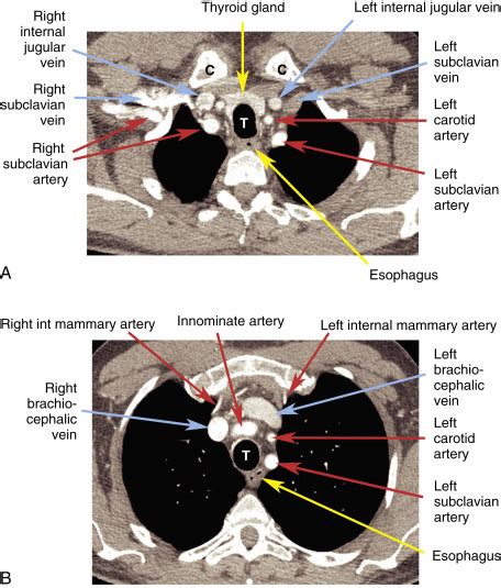 Mediastinum Introduction And Normal Anatomy Radiology Key
