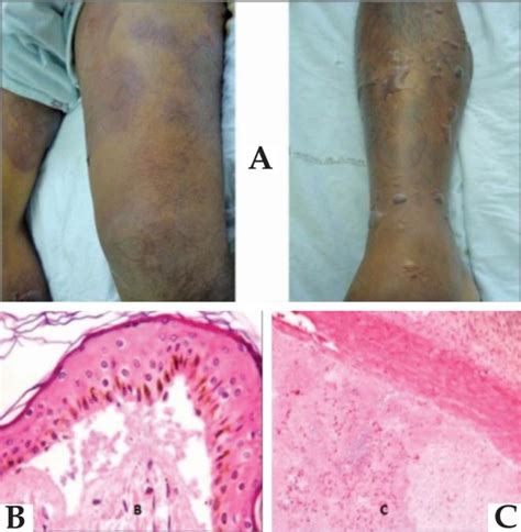 A Pictures Of Skin Lesions Multiple Tense Bullae And Intense Edema
