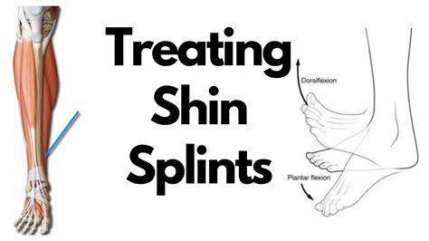 Treating Shin Splints Youtube