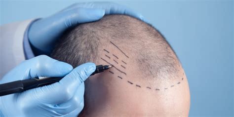 Hair Transplant Turkey Cdi Europe