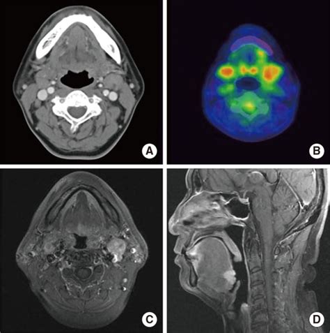 Image Findings A Neck Computed Tomography Ct Contrast Enhanced