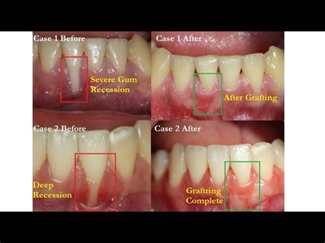 Dental Bone Graft Healing Stages