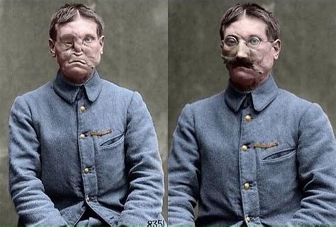 Ww1 Photos And Info On Instagram “disfigured French Soldier Before And