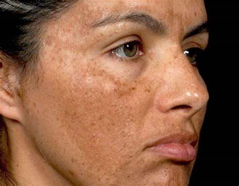 Melasma Causes Symptoms Diagnosis And Best Treatment For Melasma On Face