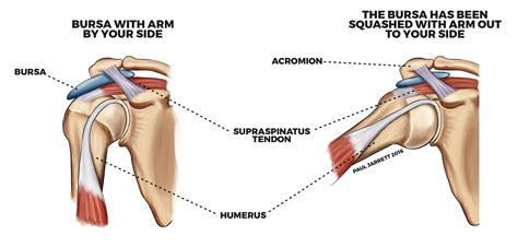 Diagram Of Shoulder Impingement Shoulder Pain Guide Shoulder Pain