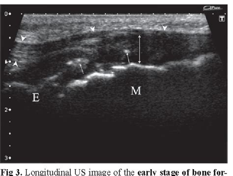 Figure 3 From Osgood Schlatter Disease In Ultrasound Diagnostics A