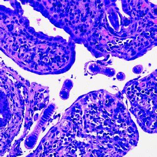 Hematoxylin And Eosin Stain Of The Jejunal Mucosal Biopsy