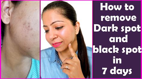How To Remove Dark Spots And Black Spots On Face At Home In 7 Days Get