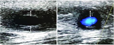 Ultrasound Of The Temporal Artery With Halo Sign Characterised By