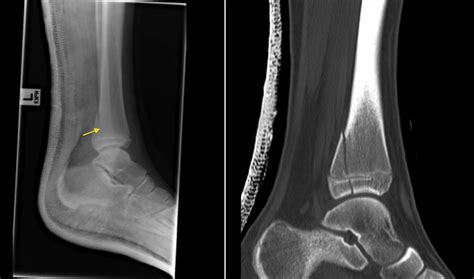 Salter Harris Iv Fracture Radiograph And Ct Radiology At St
