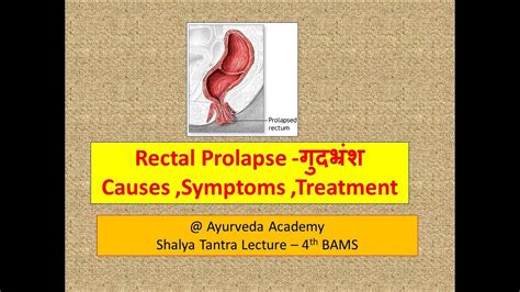 Rectal Prolapse L What Is Rectal Prolapse L Can Rectal Prolapse Be