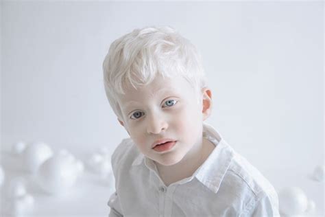 Pin On Albinos