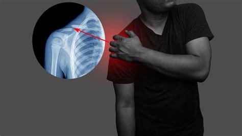 Broken Collarbone Symptoms And Diagnosis
