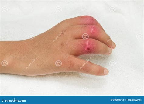 Ferimento Em Mão Cid