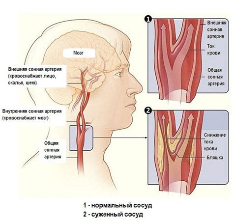 Carotid Artery Stenosis Treatment And Symptoms