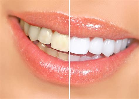 teeth whitening and bleaching cirocco dental center