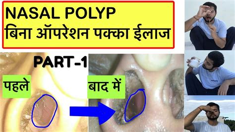 Nasal Polyps Symptomscauses And Treatment नाक में मांस बढ़ना Polyp