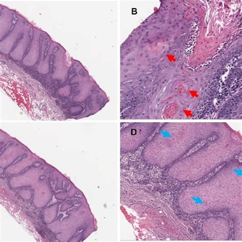 Classic Examples Of Proliferative Verrucous Leukoplakia Cases Belonging