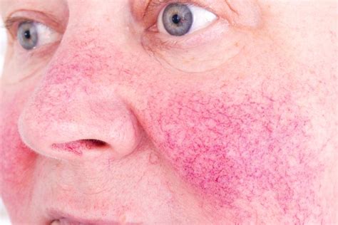 Symptoms Causes And Treatments Of Perioral Dermatitis Facty Health