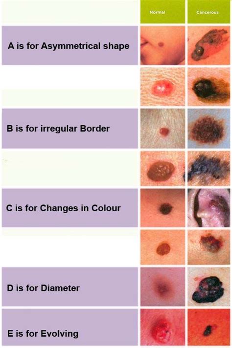 131 Best Images About Melanoma On Pinterest Wear Sunscreen New Skin