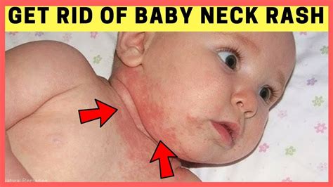 Baby Neck Rash Causes Symptoms And Home Remedies