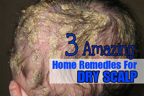 3 Amazing Home Remedies For Dry Scalp
