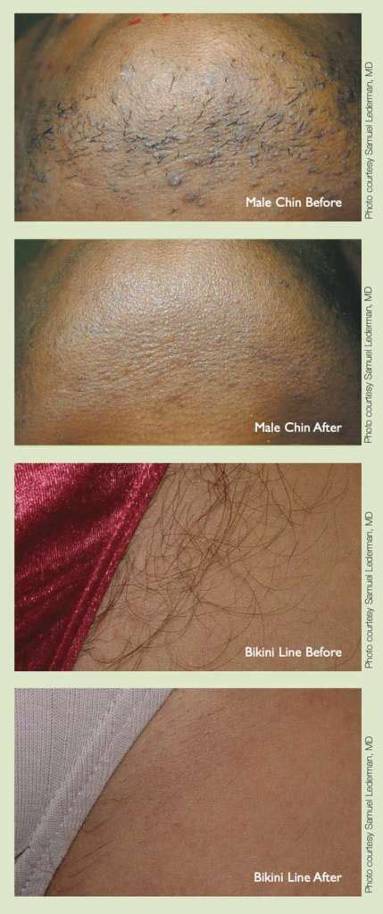 Permanent hair removal malaysia (effective laser treatment). Laser Hair Removal - Great Falls OBGYN Associates