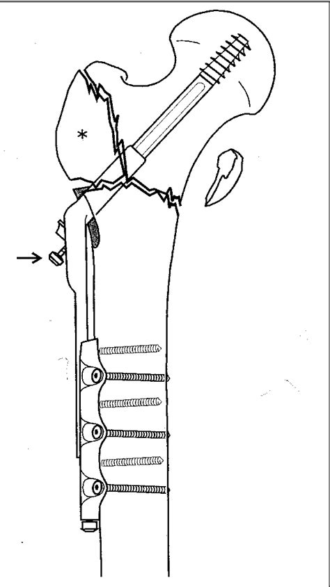Figure 1 From The Role Of The Greater Trochanter In Fracture Stability
