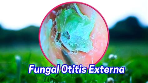 Fungal Otitis Externa The Tympanic Membrane Is Not Blocked At All And